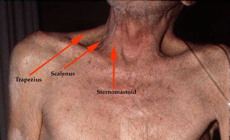 Accessory Inspiratory Muscles