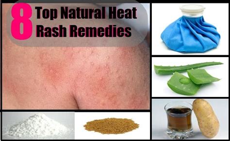 8 Top Natural Heat Rash Remedies | Rashes remedies, Heat rash, Heat ...