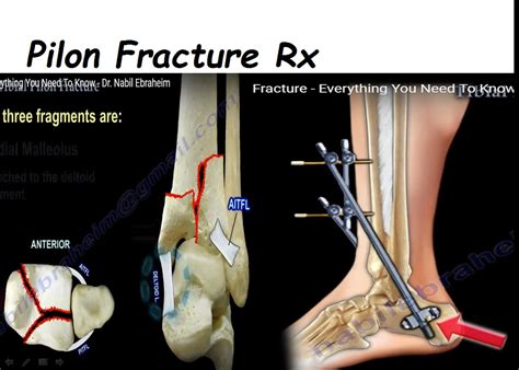 Tibial Pilon fracture Management — OrthopaedicPrinciples.com