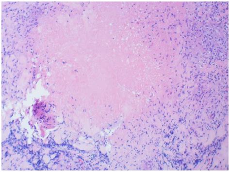 Necrotizing granuloma found on pleural biopsy. | Download Scientific ...