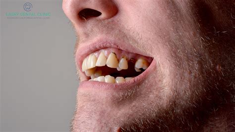 Do You Have Rotten Teeth? Symptoms, Pain, and Treatment