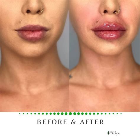 Lip Filler Before and After | Lip fillers cost, Lip fillers, Lip ...