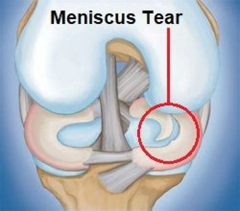 Meniscus tears are common knee injuries. Find out about causes symptoms ...