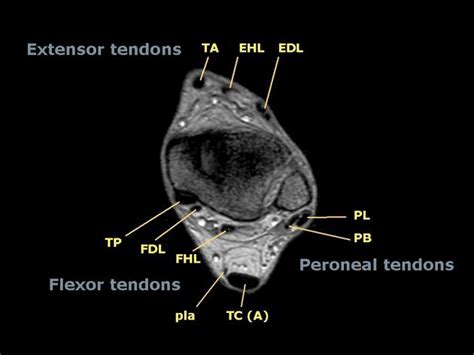 Foot Muscles Mri - Accessory Muscles Of The Ankle Radsource - Use your ...