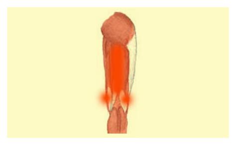 Hamstring – Tendinitis – Symptoms and Diagnosis | Alternative Muscular ...