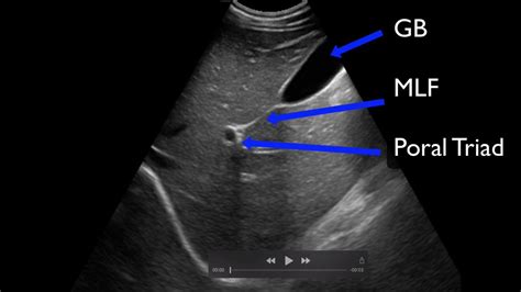 Finding the CBD - Ultrasound Troubleshoot | Issue finding the Common Bile Duct (CBD)? You are ...