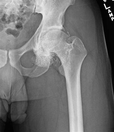 Synovial osteochondromatosis causes, symptoms, diagnosis, treatment & prognosis