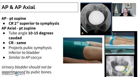 Urinary Imaging Radiology # 3 Cystogram - YouTube