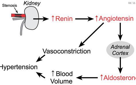 renal artery stenosis. - Medcase