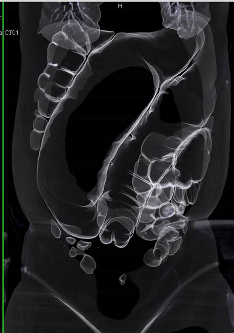 Sigmoid Volvulus - Colon Case Studies - CTisus CT Scanning