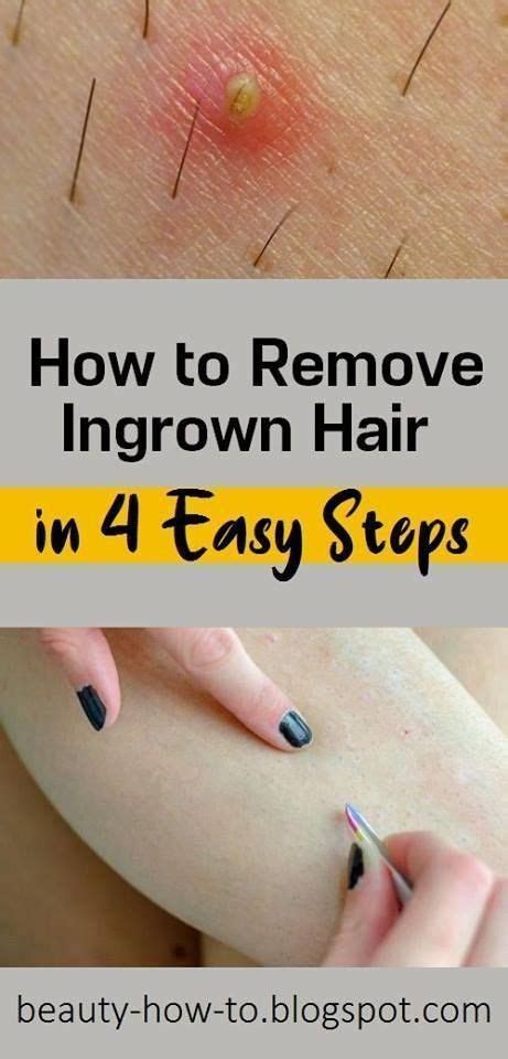 How to Remove Ingrown Hair in 4 Easy Steps | Ingrown hair removal ...