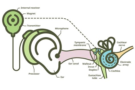 Cochlear Implant Diagram