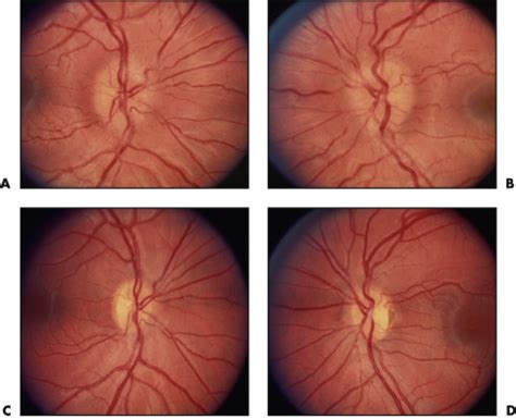 Swollen disc/s, normal vision: (Note: for swollen disc/s with blurred ...