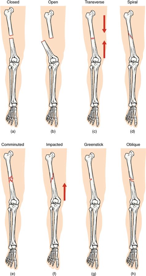 Fractures: Bone Repair · Anatomy and Physiology