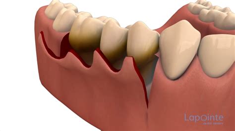 Periodontal flap approach surgery - YouTube