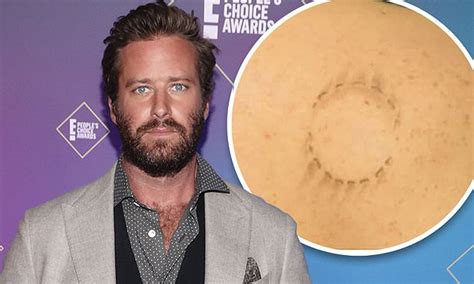 Armie Hammer docuseries will remove image of bite mark taken from ...