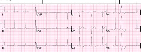 Dr. Smith's ECG Blog: Is it Wellens' Syndrome?