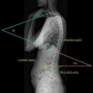 Method for measuring the spinal curve amplitudes. The lumbar curves... | Download Scientific Diagram