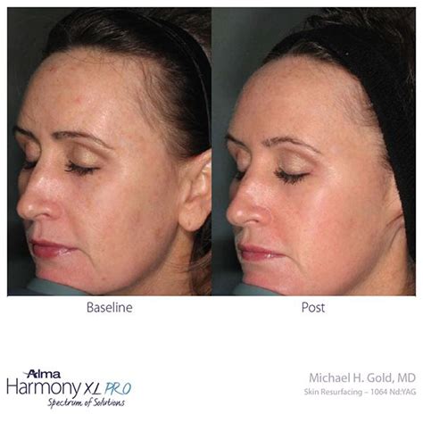 Clearlift Laser Treatment | Skin Tightening, Anti Ageing | The Hogarth Medispa | Chiswick, West ...