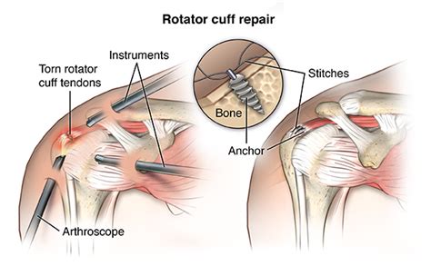 Rotator Cuff Repair - Health Encyclopedia - University of Rochester Medical Center