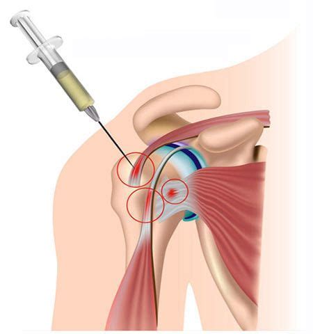 Cortisone Injections in Hampshire | Steroid Injections for Shoulder