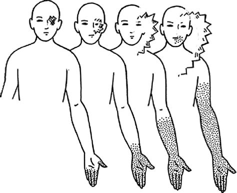 Typical-presentation-of-visual-aura-symptoms-associated-with-the-migraine-with-aura | teesneuro.org