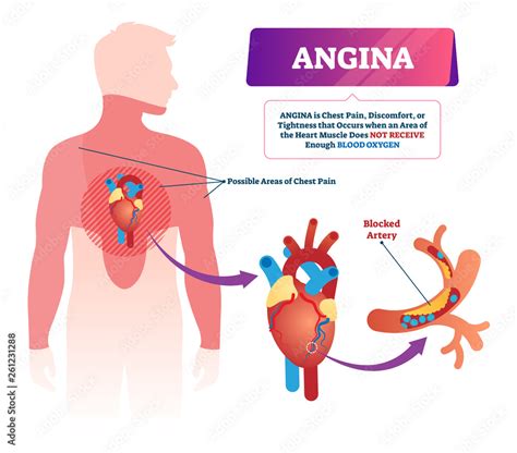 Angina vector illustration. Labeled medical chest pain and heart problem. Stock Vector | Adobe Stock