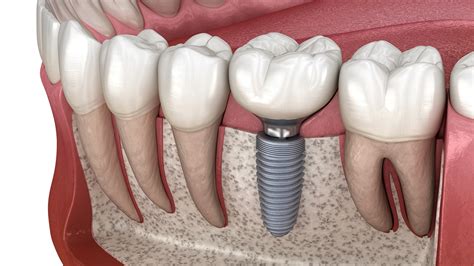 Dental Implants - Limited to Endodontics