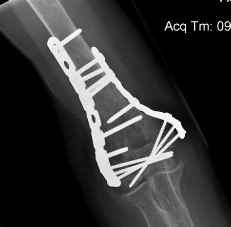 Distal Humerus Fractures | The Bone School