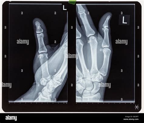 X-ray image of human hand Stock Photo - Alamy