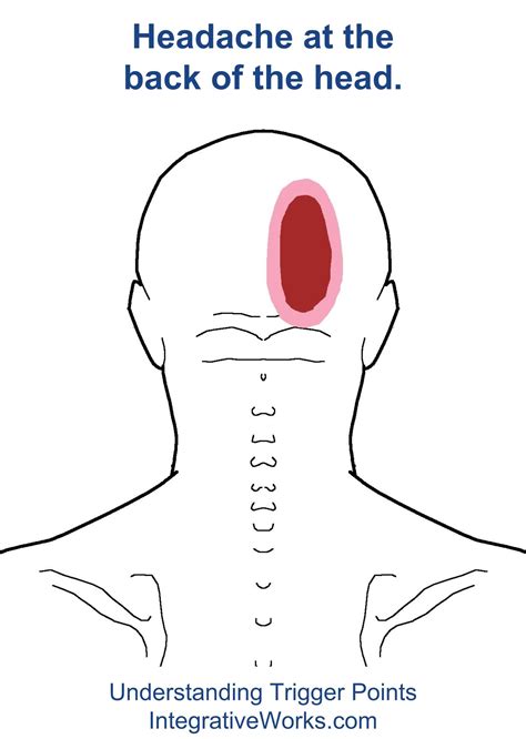 Understanding Trigger Points for Neck Pain