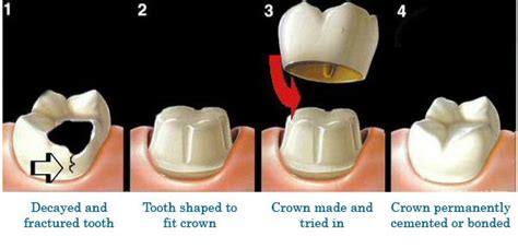 What is the procedure for Dental Crown? – Stories of Healthticket.co – Medium