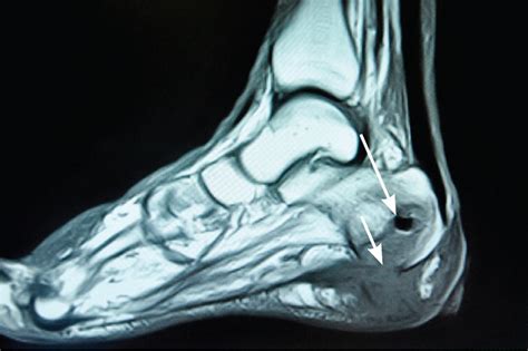 Osteomyelitis causes, risk factors, signs, symptoms, diagnosis & treatment