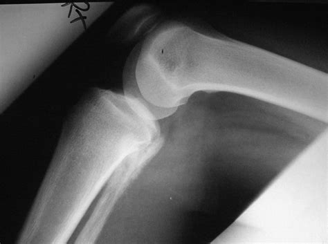 Osteosarcoma (X-Ray) - radRounds Radiology Network