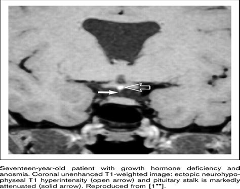 Pituitary stalk lesions : Current Opinion in Endocrinology, Diabetes ...