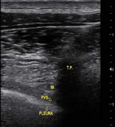 Figure: Showing Ultrasound image of Paravertebral block using Linear... | Download Scientific ...