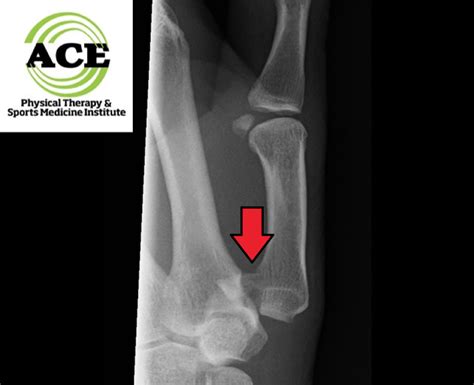 Bennett Fracture Alexandria | Thumb Rehabilitation Arlington