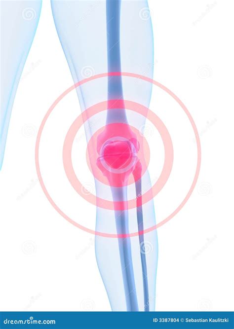 Knee inflammation stock illustration. Illustration of biology - 3387804