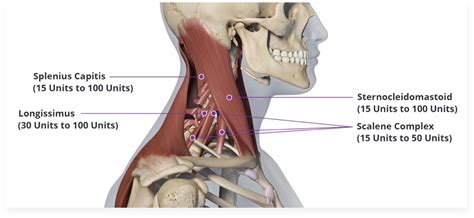 Cervical Dystonia