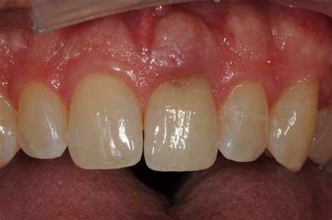 tooth root resorption Archives - Dr Gennero