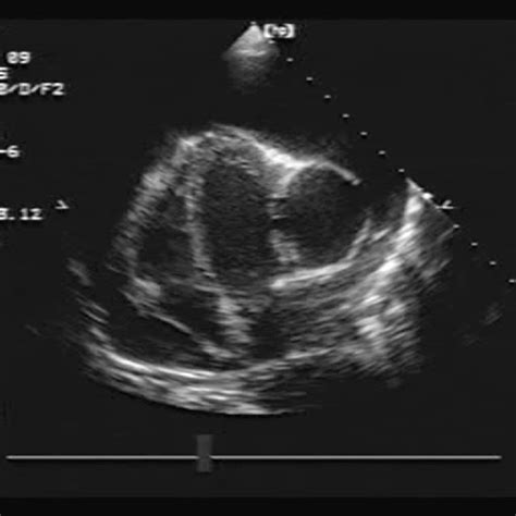 Surgical photograph of the left ventricular aneurysm. | Download ...