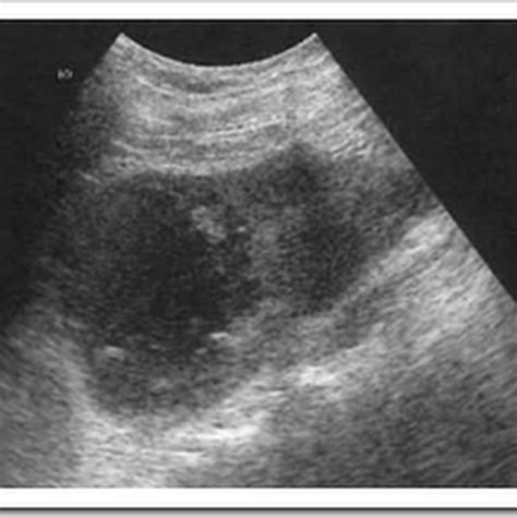 Ultrasound images of Renal abscess - Radiology Imaging