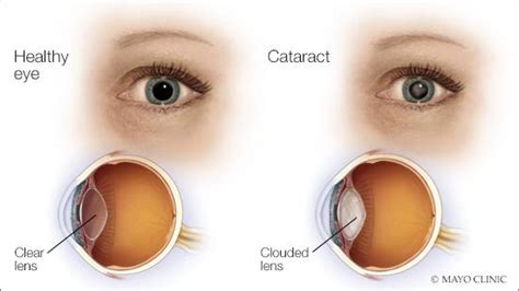 Mayo Clinic Q and A: When can cataract surgery wait? - Mayo Clinic News Network