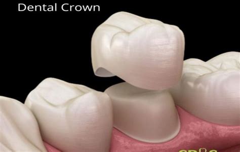 Why do we need to do a dental crown on tooth after Root Canal Treatment? - Cosmetic Dental ...