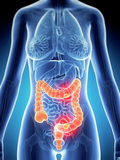 Colorectal Cancer Diagram