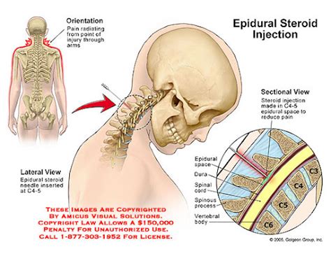 Cervical interlaminar Epidural steroid injection – iSPINE