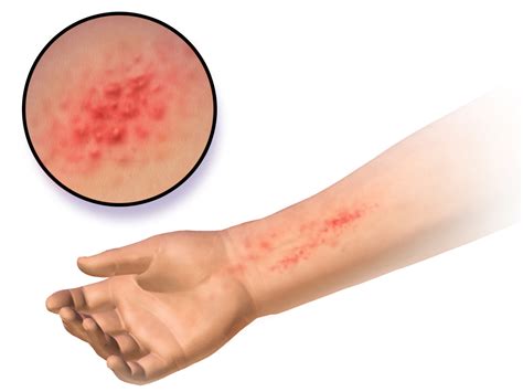 Allergic contact dermatitis - Wikipedia