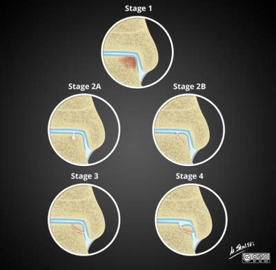 Osteochondral lesion of talar dome - Riverside Podiatry