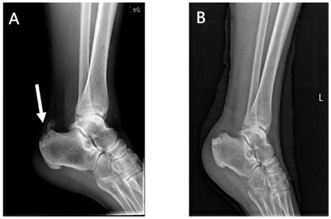 JPM | Free Full-Text | Treatment of Calcific Insertional Achilles ...