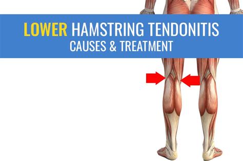 Lower hamstring tendonitis – Causes, symptoms, treatment, and recovery times